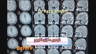 تومور مغزی کلیوم