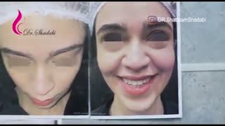 فیلم بلافاصله پس از عمل بینی استخوانی