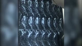 فیلم واقعی جراحى تنگى کانال گردن