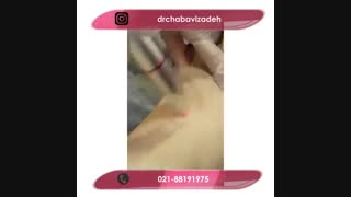 فیلم واقعی رفع تیرگی زیربغل با لیزر
