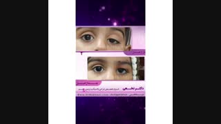فیلم نمونه جراحی افتادگی یا پتوز پلک مادرزادی کودک 1 و نیم ساله