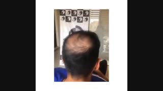 اسکالپ | میکرو اسکالپ | تاتو سر