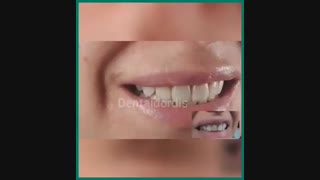 جراحی افزایش طول تاج یا لیفت لثه  به همراه 6 واحد کامپوزیت