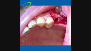 ایمپلنت دندان