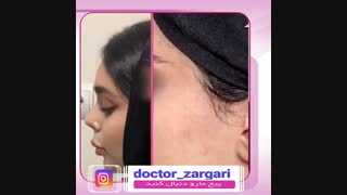 نمونه کار جراحی بینی دکتر زرگری