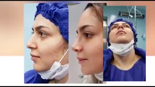 فیلم واقعی جراحی بینی استخوانی - قبل و بعد از عمل