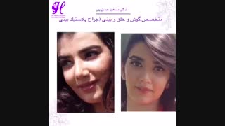 جراحی زیبایی بینی انجام شده توسط دکتر مسعود حسن پور