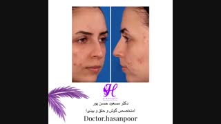 نمونه جراحی زیبایی بینی دکتر حسن پور