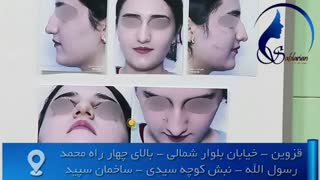 فیلم جدید جراحی زیبایی بینی توسط دکتر صفدریان