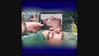 فیلم جراحی بینی مردانه طبیعی