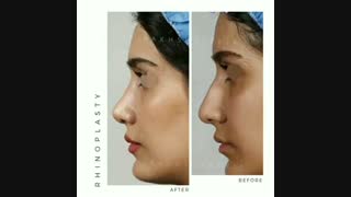 نمونه کار عالی و زیبای عمل بینی طبیعی زنانه