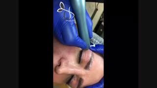 فیلم لیفت پلک با پلاسما