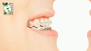 چه روش هایی برای کمتر دیده شدن دستگاههای ارتودنسی وجود دارد؟ | کلینیک دندانپزشکی ایده آل
