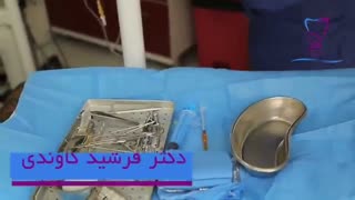 دکتر فرشید کاوندی جراح فک و صورت پالپوتومی