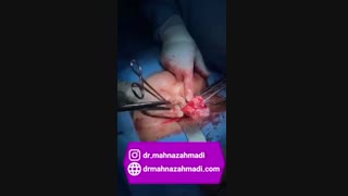 عمل خارج کردن رحم و میوم