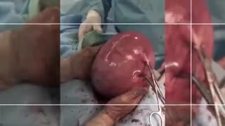 فیبروم خیلى بزرگ در خانم 48 ساله