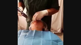 رفع غبغب در یک جلسه