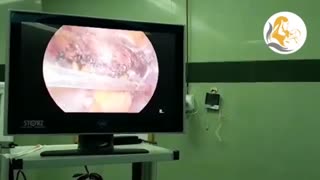 عمل لاپاراسکوپی هیسترکتومی