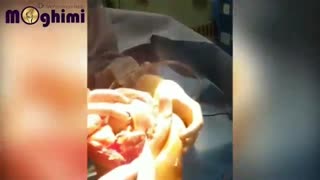 فیلم واقعی تعویض مفصل زانو در خانم ۶۶ ساله