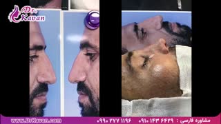 عمل بینی توسط دکتر کاوان