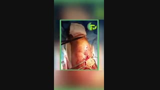 فیلم واقعی جراحی نکروز پوست