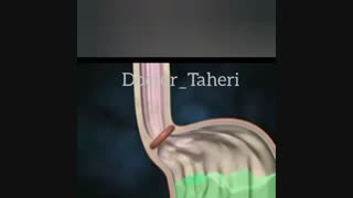 انیمیشن رفلاکس معده