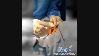 فیلم جراحی زیبایی گوش برجسته