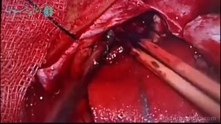 جراحی مننژیومای فالکسوتنتوریال در یک خانم جوان