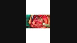 تومور کاروتید بادی