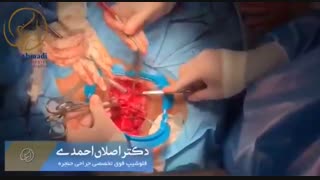 عمل بازسازی راه هوایی با برداشتن تنگی و تراک بیمار