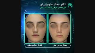 جراحی بینی | فوق تخصص جراحی پلاستیک | دکتر عبدالرضا روئین تن