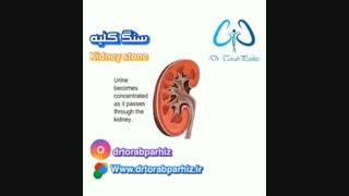 انیمیشنی درباره سنگ کلیه
