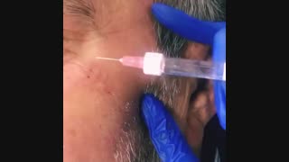 تزریق مزوژل دور چشم