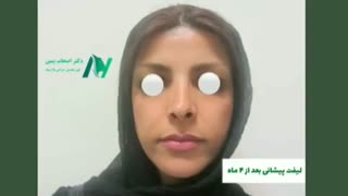 فیلم واقعی لیفت پیشانی برداشتن زگیل