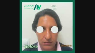 فیلم واقعی عمل بینی و لیفت پیشانی رفع چین و چروک