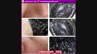 رفع جوش و لک صورت با ماسک خانگی دندان پیش