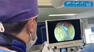 فیلم جراحی سنگ بزرگ  کلیه  به روش PCNL
