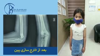 فیلم واقعی شکستگی سوپراکوندیلار هومروس