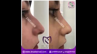 تزریق فیلر بینی
