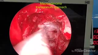 تومور بزرگ آدنوم هیپوفیز