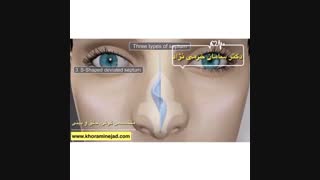 فیلم جراحی انحراف تیغه بینی