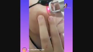 فیلم واقعی از بین بردن کک و مک با لیزر!
