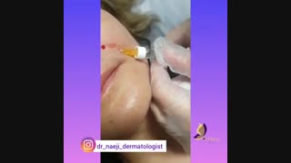 فیلم واقعی تزریق فیلر خنده در ساوه