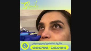 فیلم مزوتراپی چشم