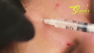 تزریق بوتاکس و فیلر چانه در تهران