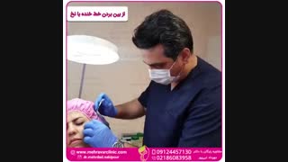 از بین بردن خط خنده با نخ