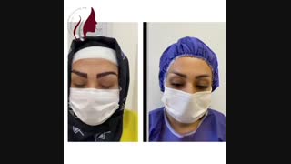 فیلم واقعی کاشت ابرو و رضایت مراجعه کننده از نتیجه