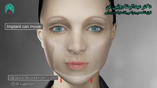 انیمیشن پروتز چانه | فوق تخصص جراحی پلاستیک | دکتر عبدالرضا روئین تن