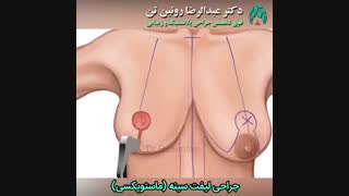 جراحی لیفت سینه ( ماستوپکسی ) | فوق تخصص جراحی پلاستیک | دکتر عبدالرضا روئین تن
