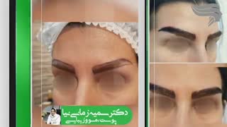 کاشت ابرو  بعد از یکسال